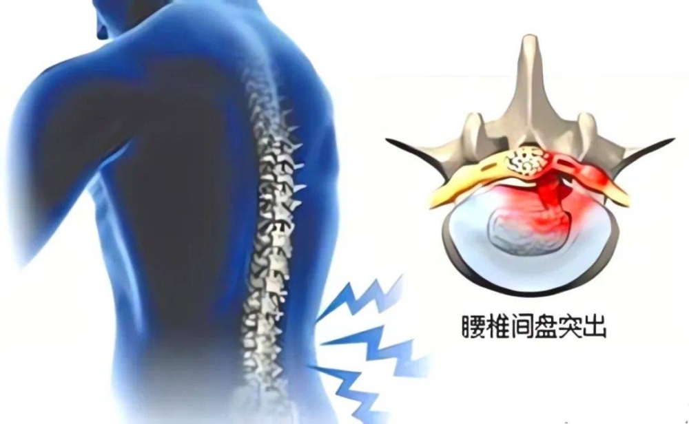 腰椎间盘突出的原因、治疗与康复